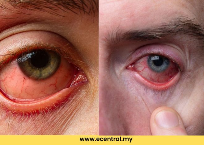 Punca, Simptom dan Cara untuk Merawat