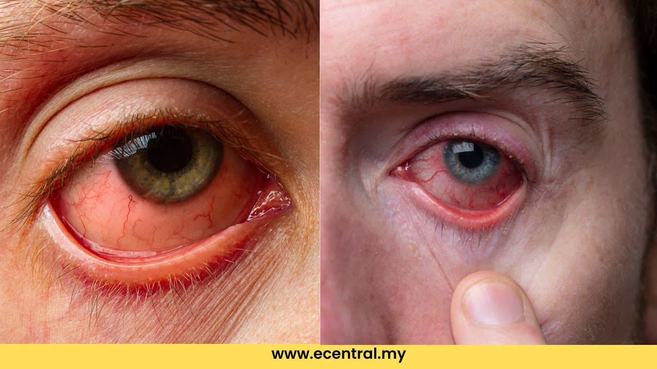 Punca, Simptom dan Cara untuk Merawat