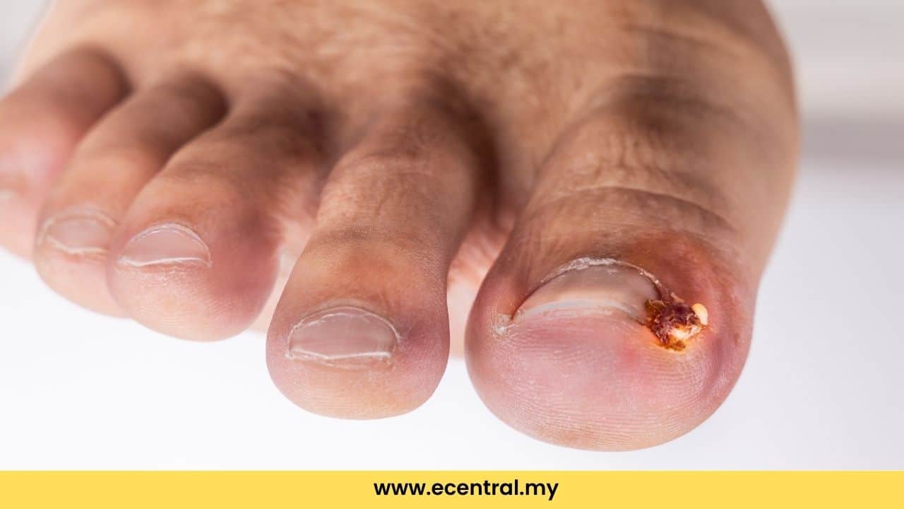 Nails don’t heal? This may be the cause