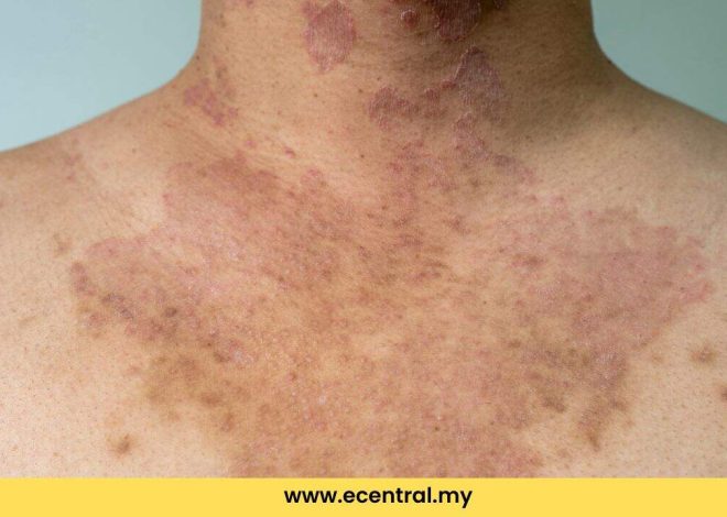 How to get rid of Panau quickly and effectively at home