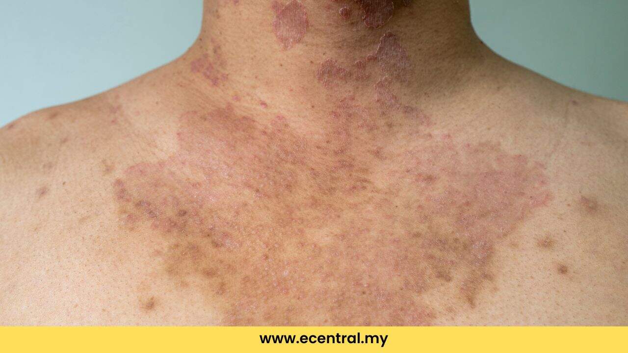 How to get rid of Panau quickly and effectively at home