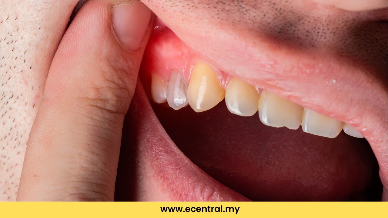 Swollen gum – Why does it happen and what do you need to do?