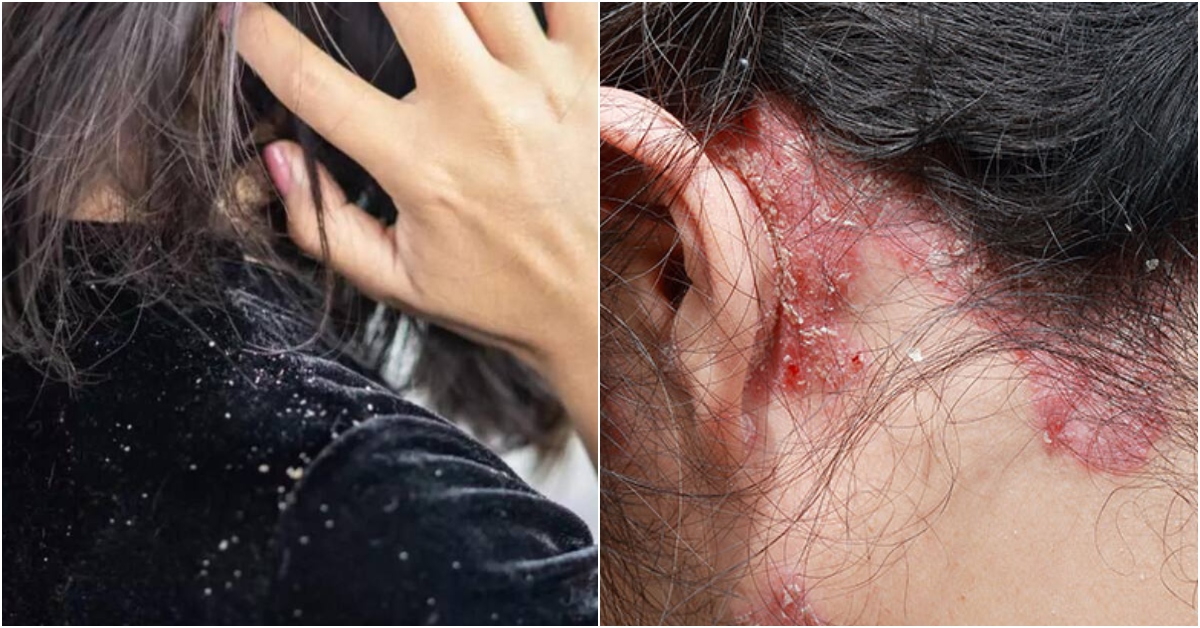 Causes, how to prevent and care