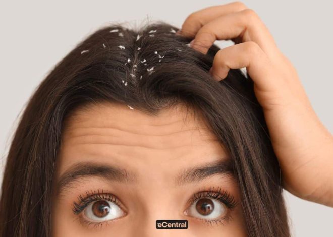 11 Ways To Eliminate Dandruff Effectively and Naturally