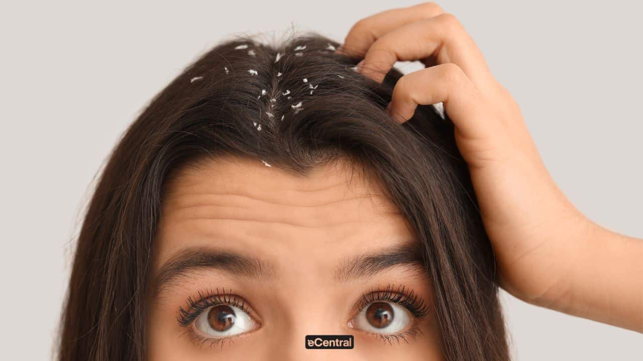11 Ways To Eliminate Dandruff Effectively and Naturally